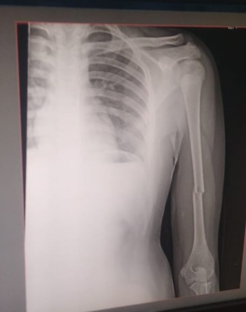 जिला अस्पताल में अव्यवस्था चरम पर: फ्रैक्चर हाथ लिए 15 वर्षीय बालक दो दिन भटकता रहा, न डॉक्टर मिले न दर्द की दवा